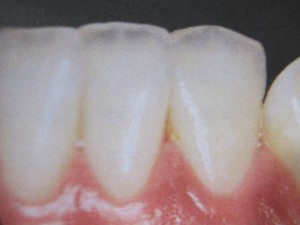 酸蝕歯の場合